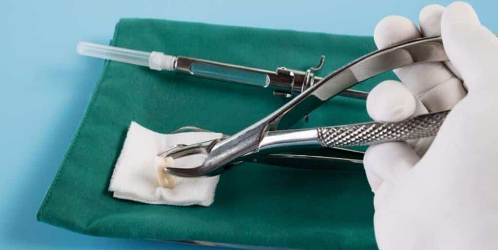 extraction of a tooth in the UK