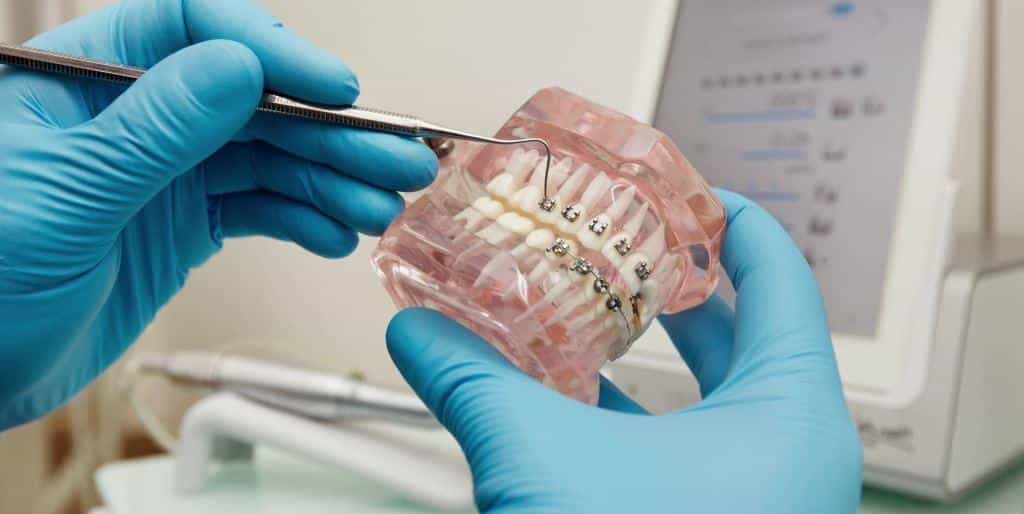 Aparate ortodontice de autocolțare în Marea Britanie 