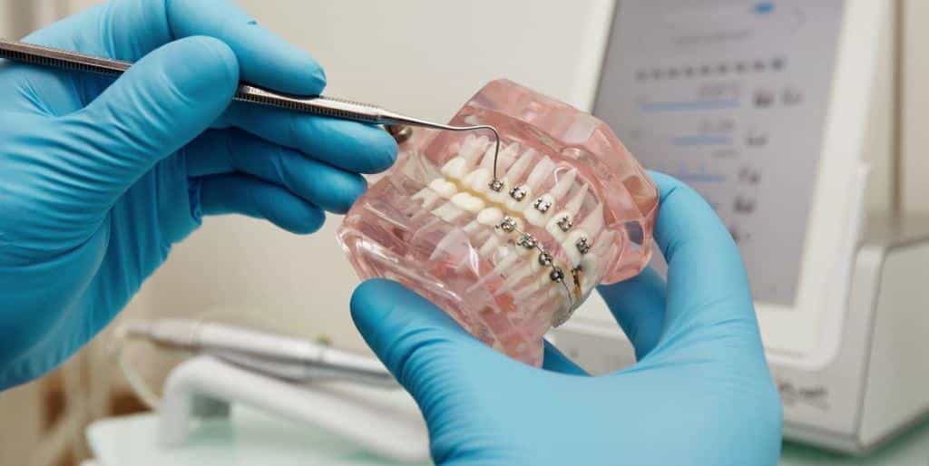 Self-ligating braces in the UK 