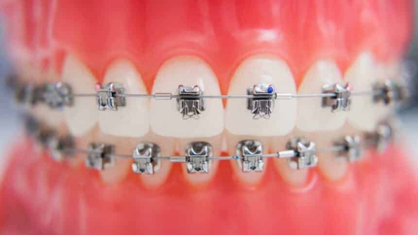 Aparatele ortodontice cu autograf în Marea Britanie - ce sunt și cât costă?