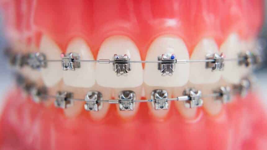 Self-ligature braces in the UK - what are they and how much do they cost?