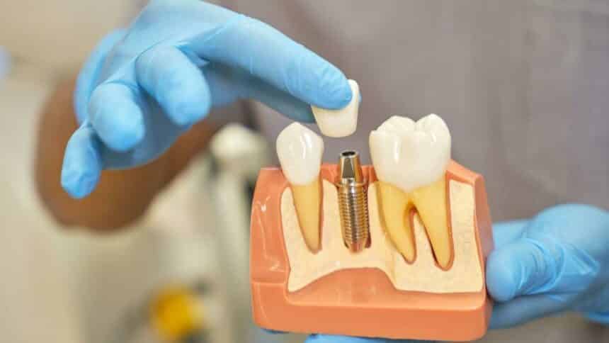 Zavedenie zubného implantátu - ako vyzerá postup?