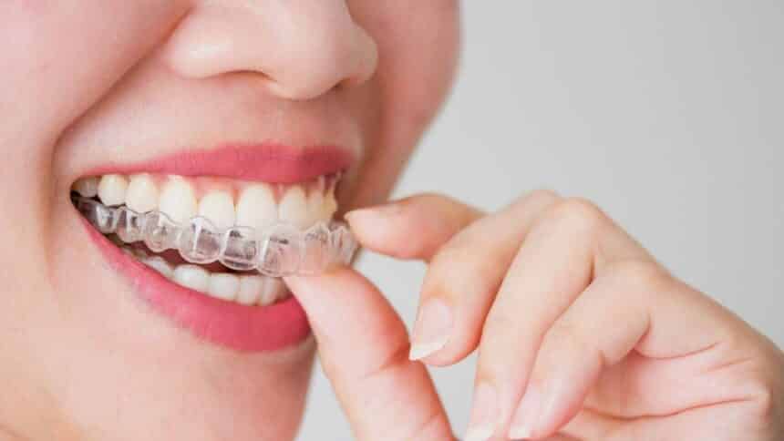 Orthodontic overlays, or what are aligners