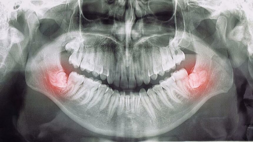 Coronectomy in the UK - what is it and what is the treatment?