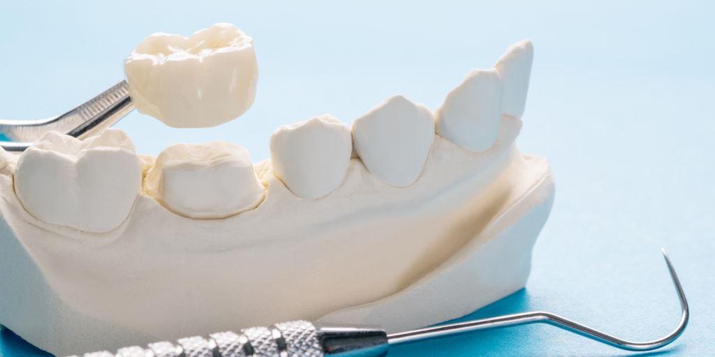 Restaurarea dintelui se poate face cu o coroană dentară