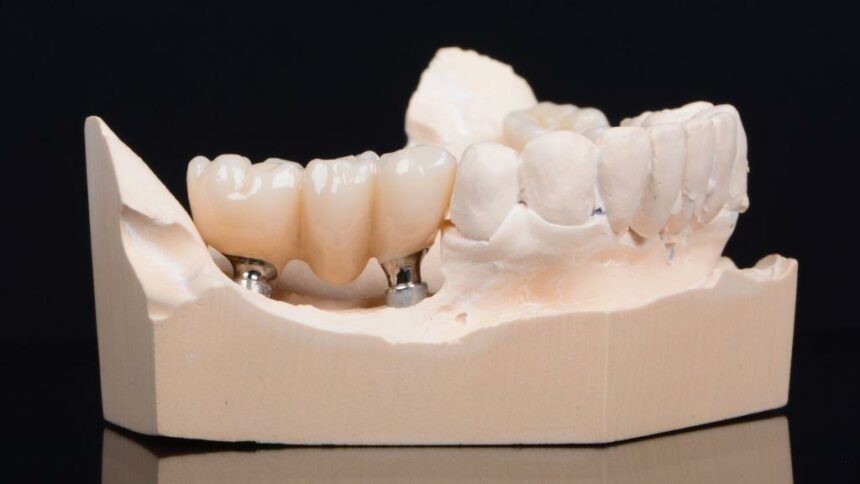 What does a dental bridge look like and how much does it cost?