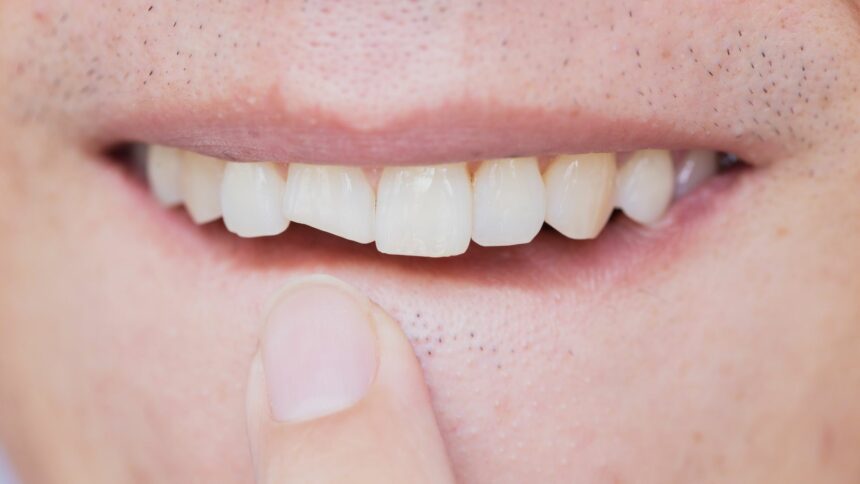 Złamany ząb – co można zrobić?
