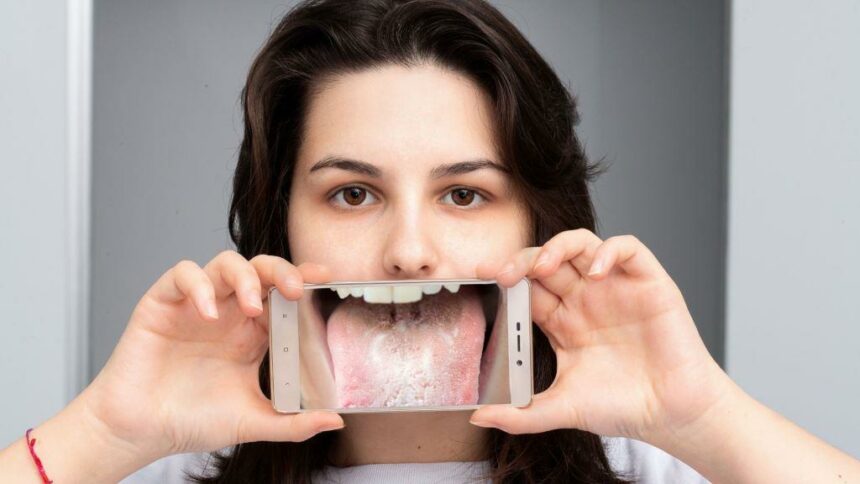 Grzybica jamy ustnej – skąd się bierze i jak ją leczyć?