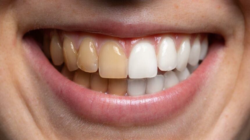 Brązowe przebarwienia na zębach – skąd się biorą i jak się ich pozbyć?