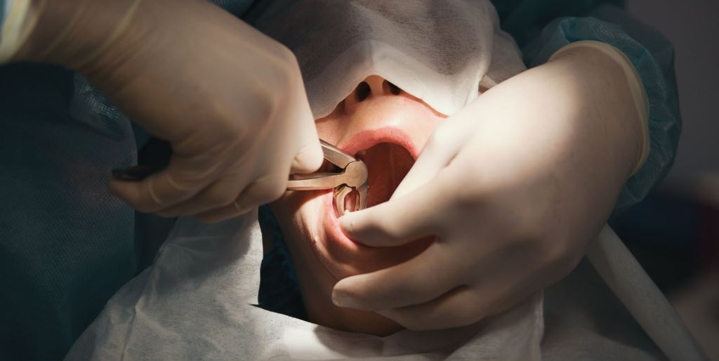 Removal of a retained tooth in the UK - what is the procedure like?