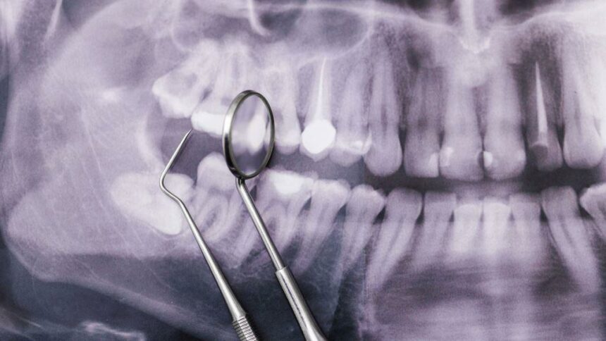 Extraction of a retained tooth in the UK