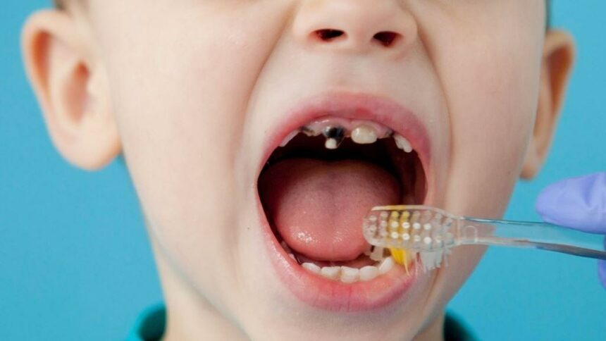 Черни зъби при дете