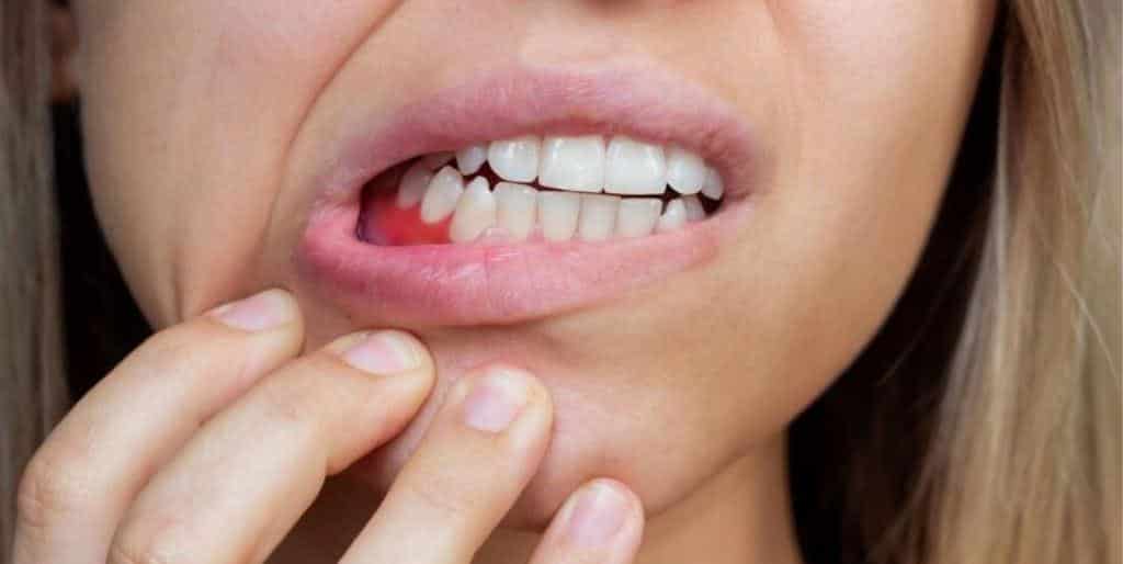 Contraindications to teeth whitening
