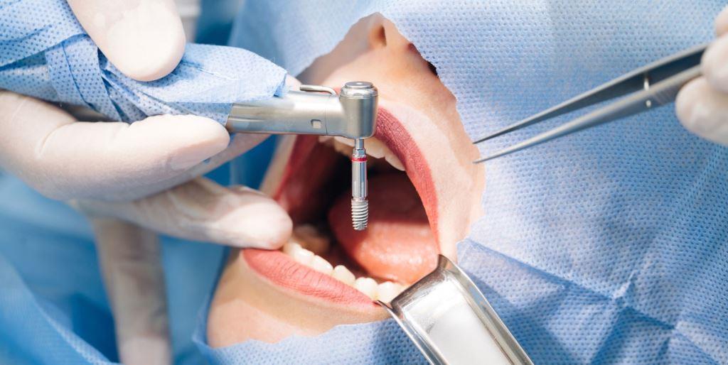 How the implant is inserted
