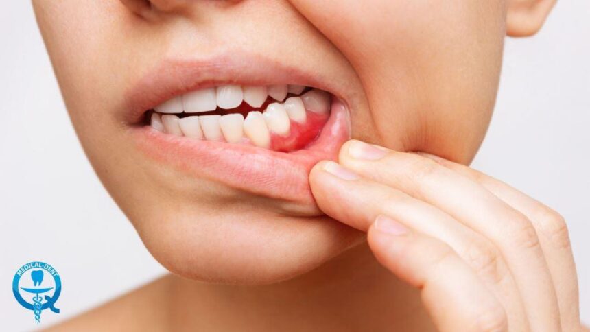 How to prevent periodontitis? 