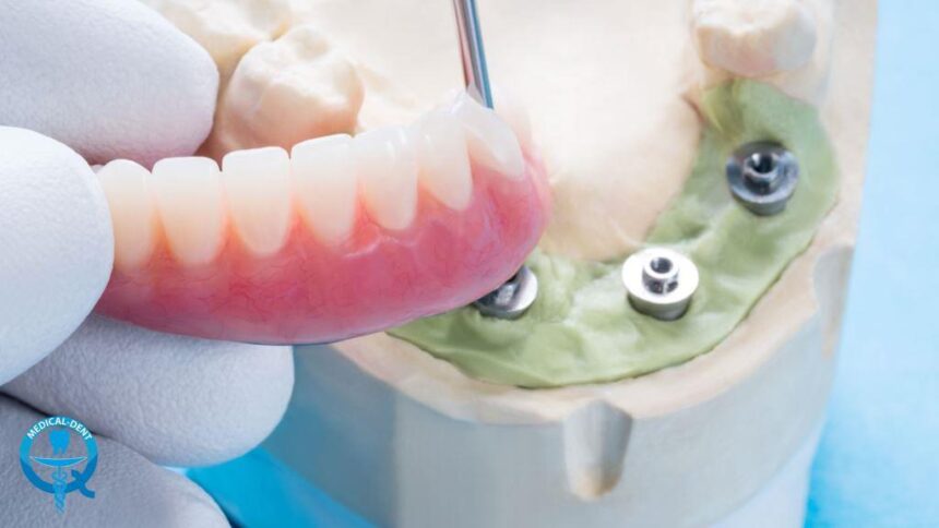 Implant-supported dentures in the UK