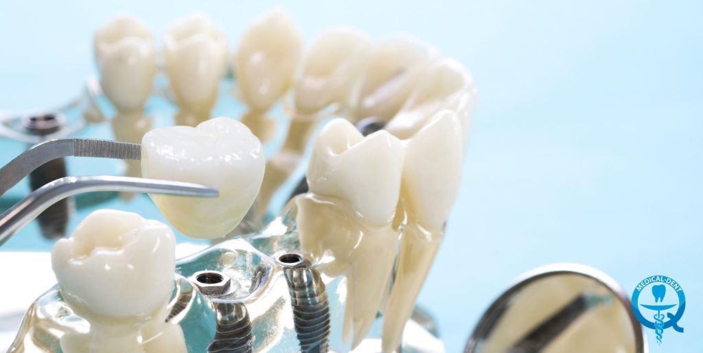 Implant-supported dentures in the UK