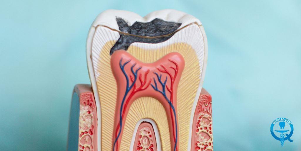 Damage to the dental pulp