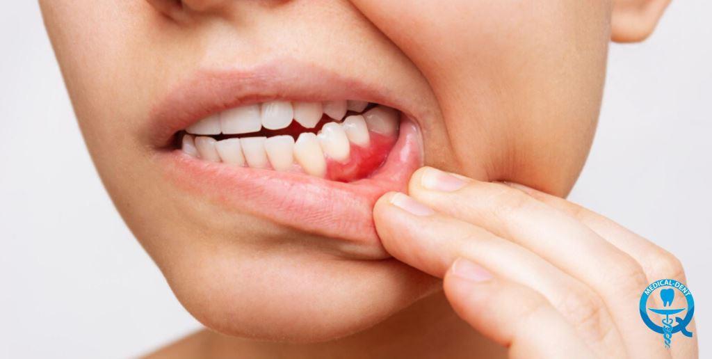 bleeding gums are one of the main symptoms of periodontal disease