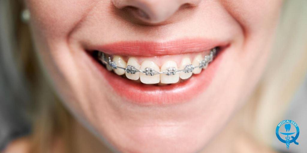 braces on hire purchase in the UK