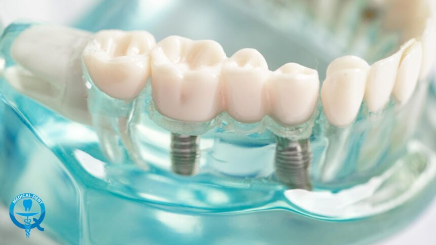Implant bridge in the UK - price and what the procedure is like