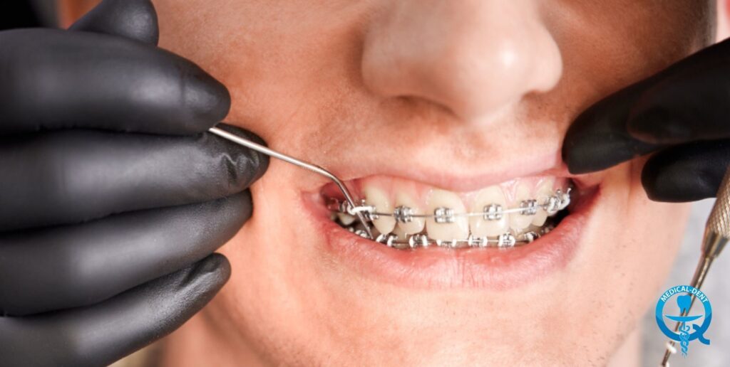 Zdjęcie przedstawia zbliżenie na usta osoby, która ma założone metalowe aparaty ortodontyczne. Widoczne są ręce dentysty, który za pomocą narzędzi dopasowuje lub reguluje aparat. Fotografia ukazuje detal zabiegu stomatologicznego.