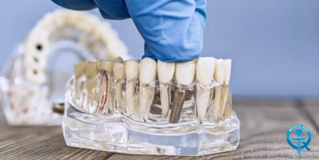 Przezroczysty model szczęki z implantami dentystycznymi i koronami, dotykany przez osobę w niebieskiej rękawiczce. W tle widoczny drugi model dentystyczny. W prawym dolnym rogu logo kliniki Medical-Dent.
