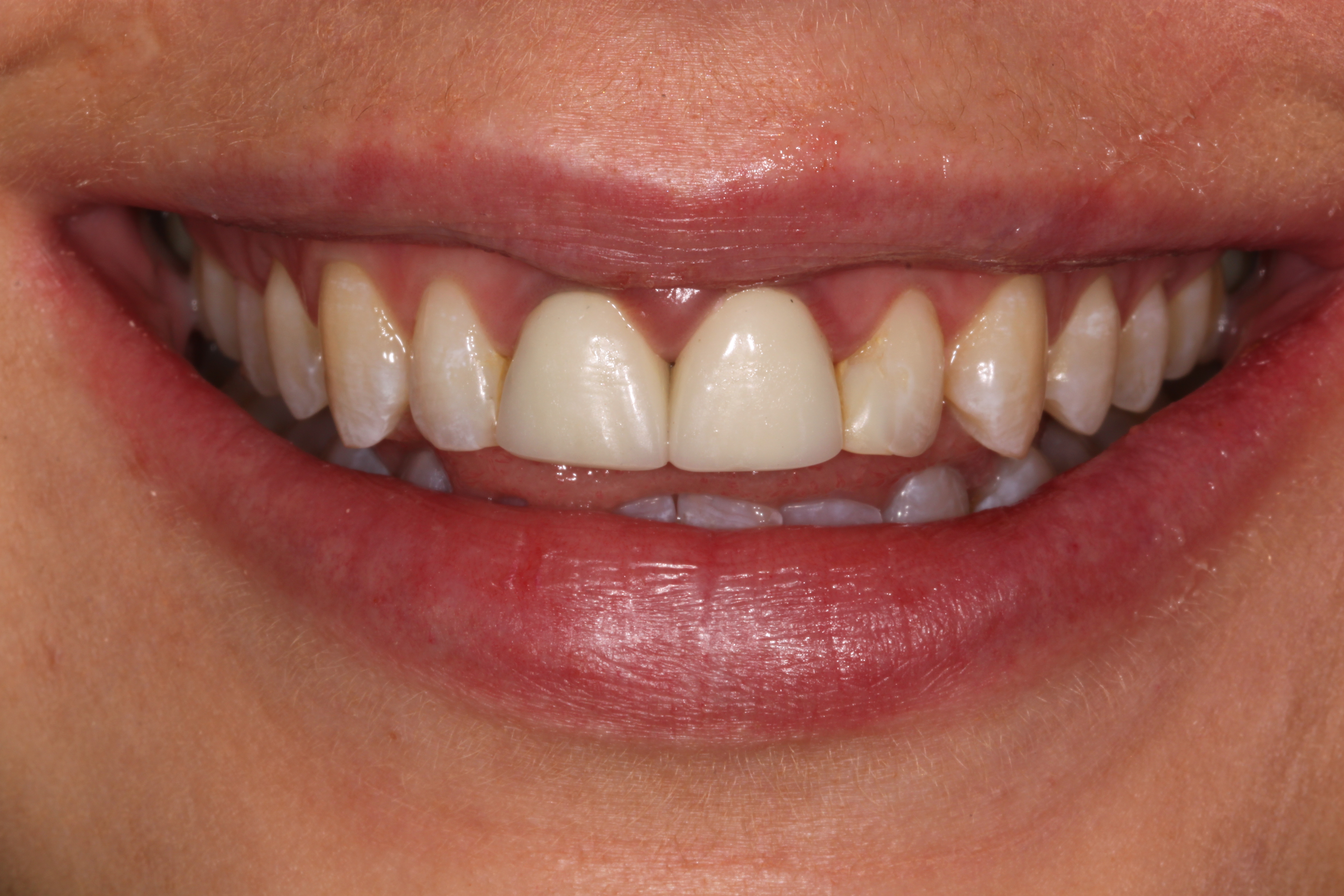 Old porcelain crowns - before replacement with EMAX