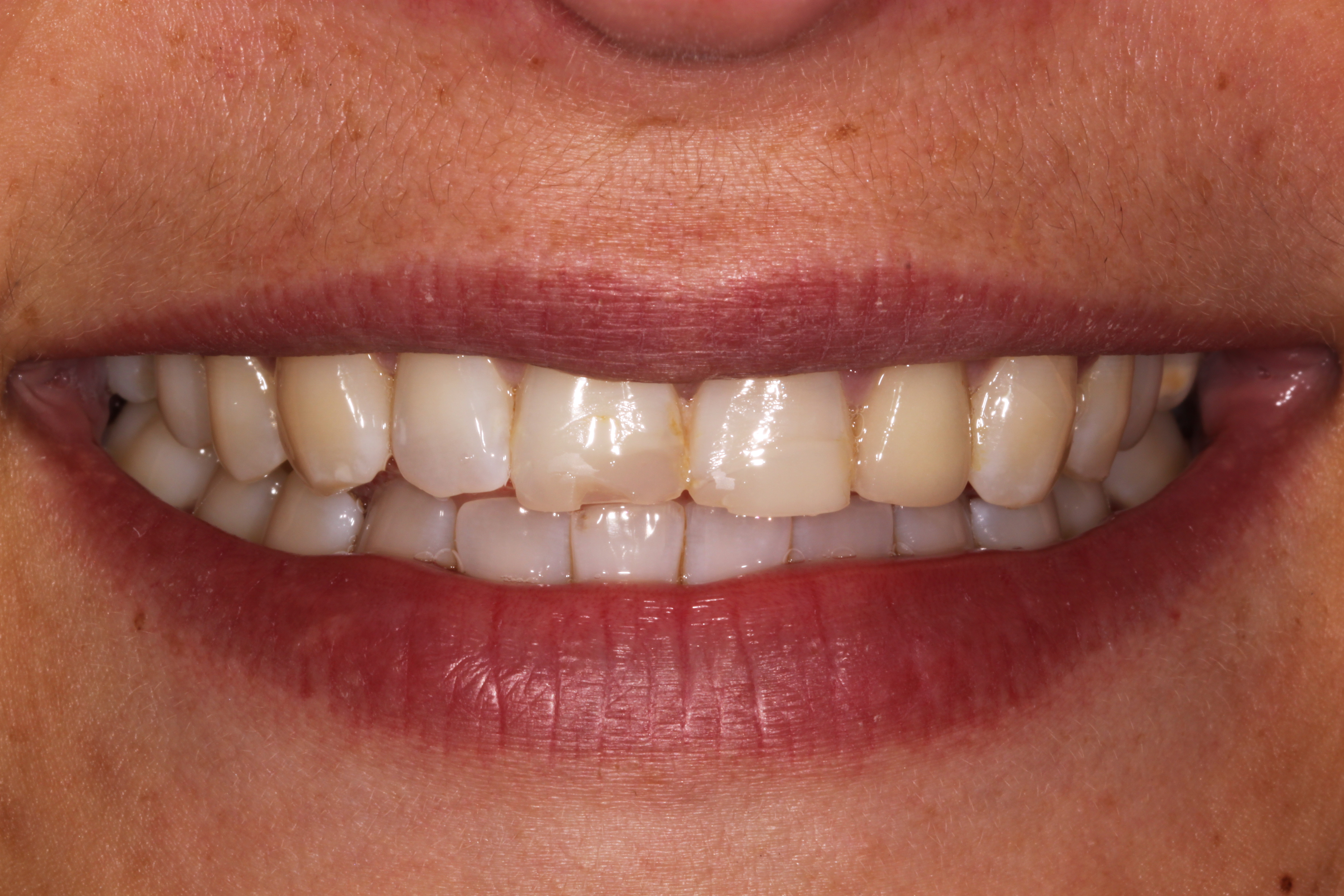 Birmingham ceramic veneers - before EMAX application