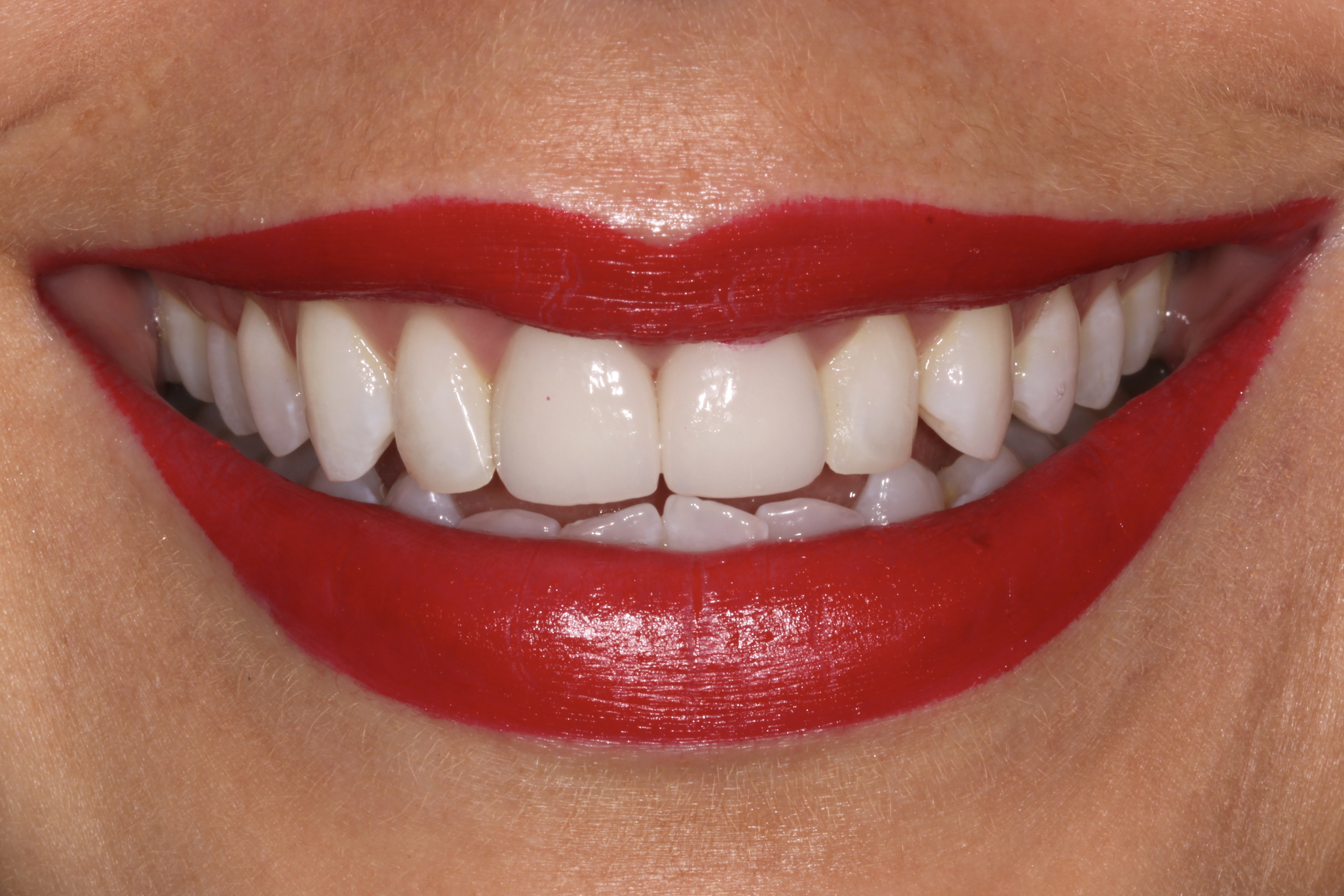 New EMAX Birmingham crowns - a natural look