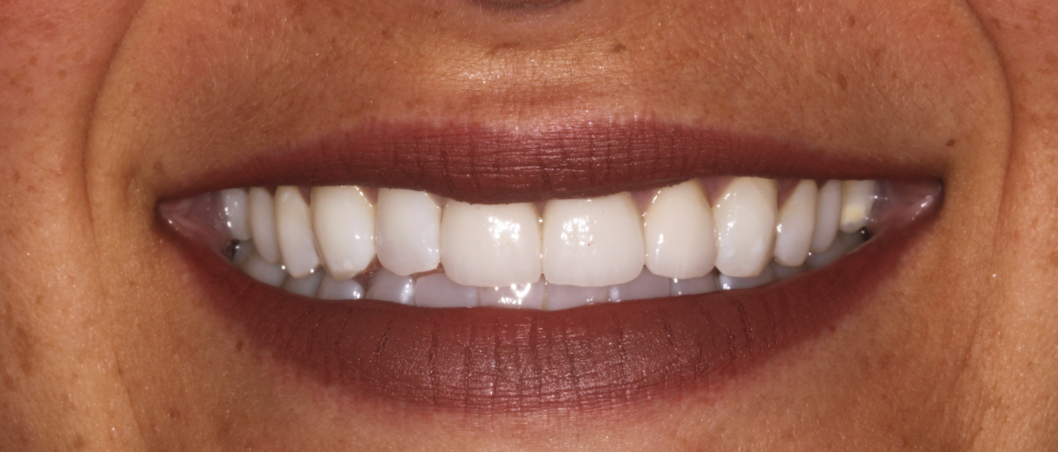 EMAX Birmingham veneers - perfect smile symmetry