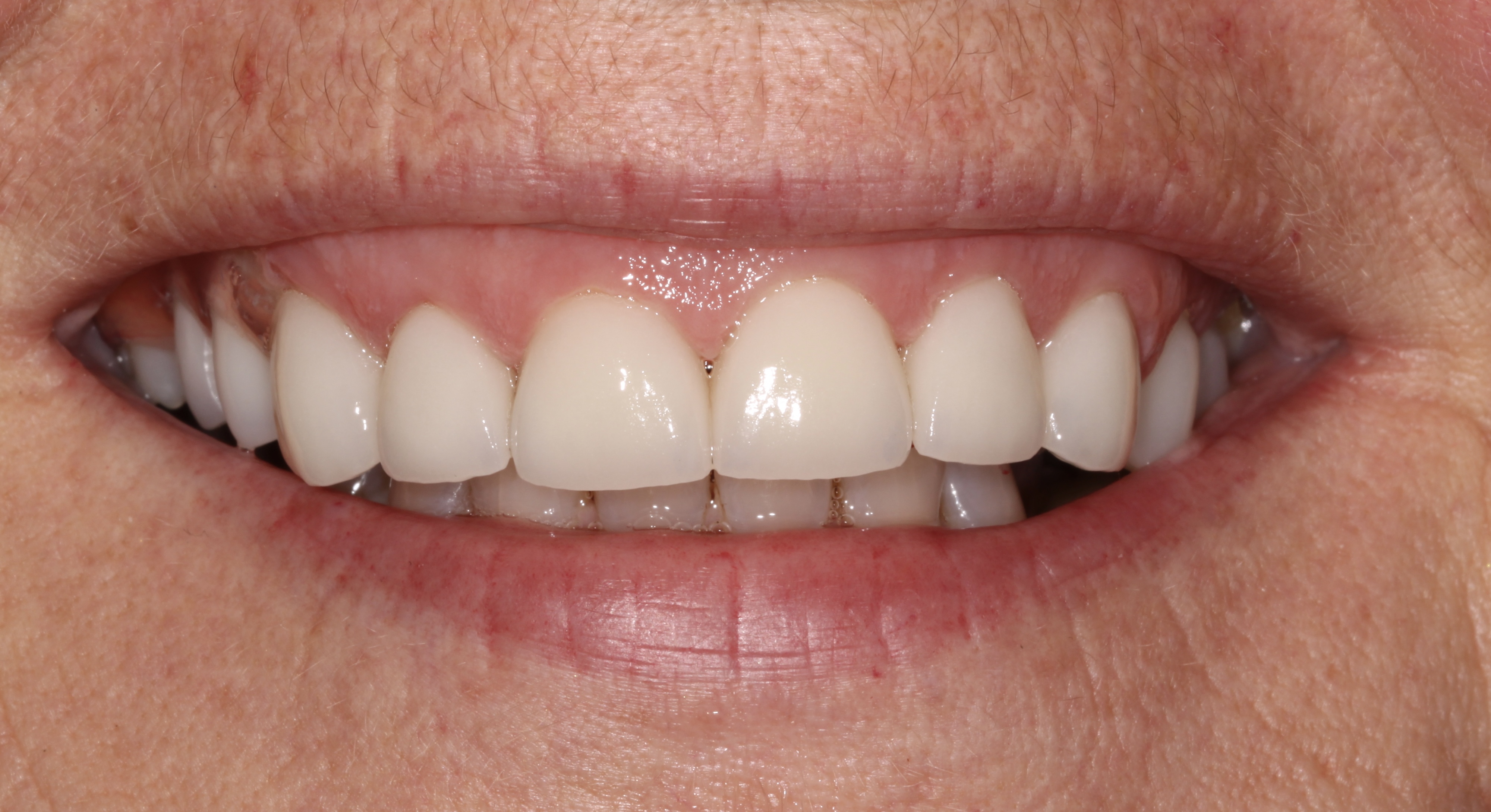 The final result of EMAX veneers - a smile like the cover