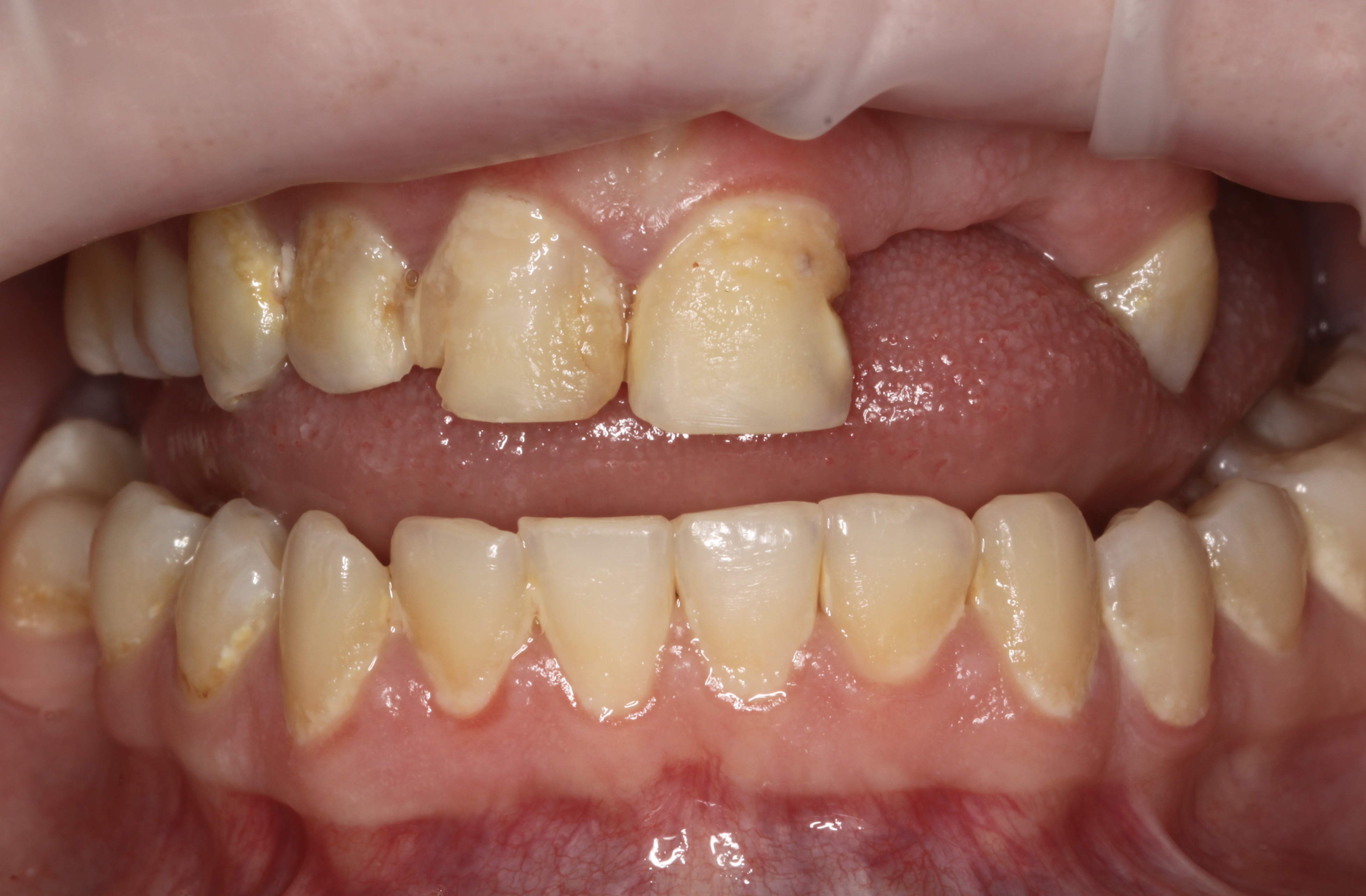 Birmingham smile transformations - before treatment with Dr Kamila Szuberska