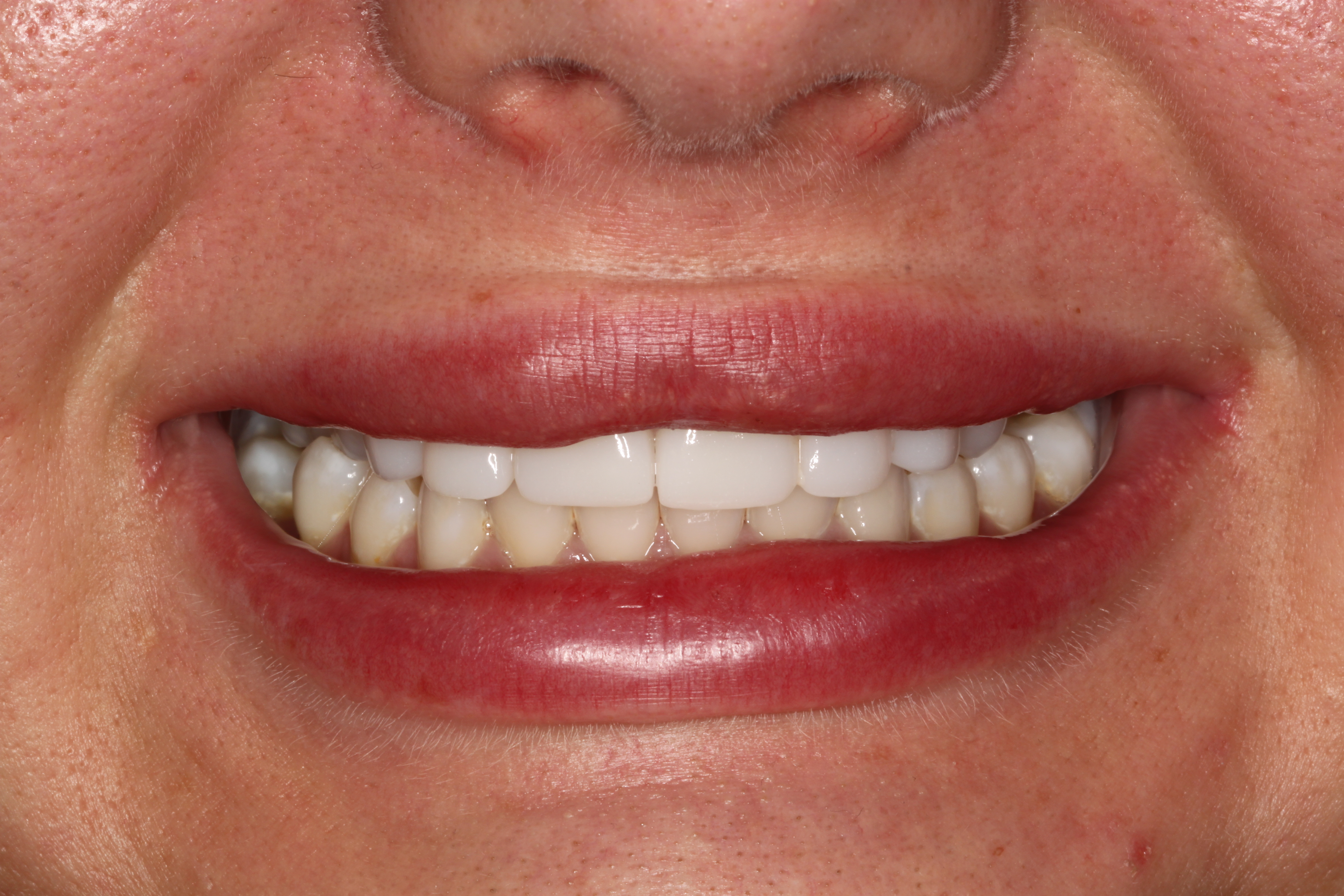 Birmingham smile transformations - after treatment with EMAX ceramics