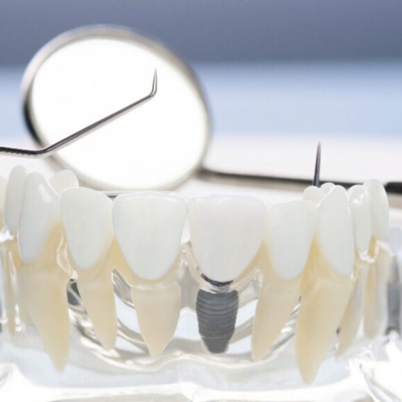 The implant treatment process - find out what it looks like step by step