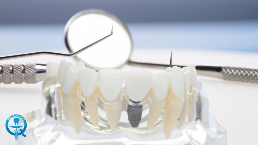 The implant treatment process - find out what it looks like step by step