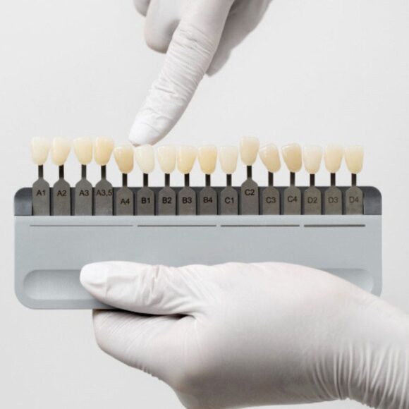 Placing veneers in the UK - what the procedure looks like