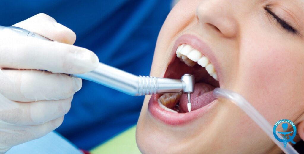A dentist wearing white gloves performs the filling procedure on a patient with an open mouth, using a blue dental instrument.