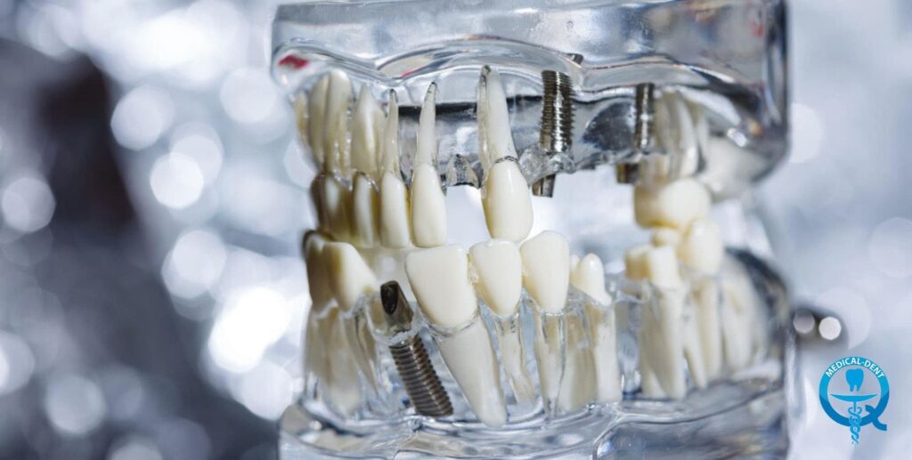 Стоматологичен модел, показващ прозрачна челюст със зъби и зъбни импланти, илюстриращ процедури по имплантиране в стоматологията.