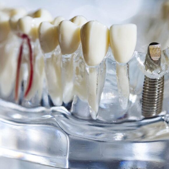 Contraindications to dental implants - when an implant is not the best solution