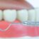 Treatment of advanced periodontitis – how not to lose your teeth