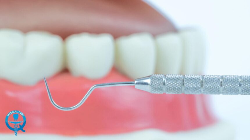 Treatment of advanced periodontitis – how not to lose your teeth