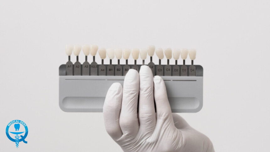 Fațete din porțelan în Marea Britanie - tot ce trebuie să știți