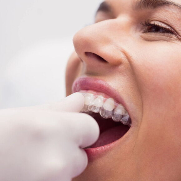 Customised trays for teeth whitening in the UK