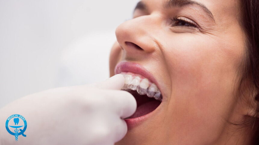 Tăvi personalizate pentru albirea dinților în Marea Britanie