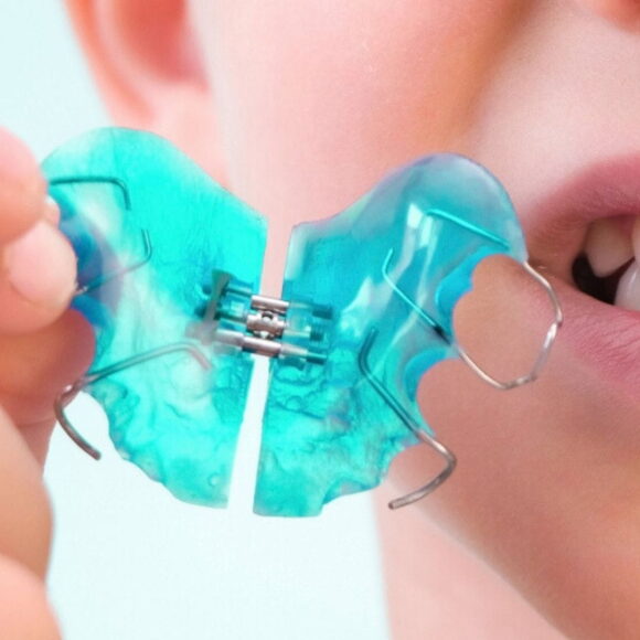 Ортодонтският апарат Twin Block - ефективен метод за лечение на малката захапка