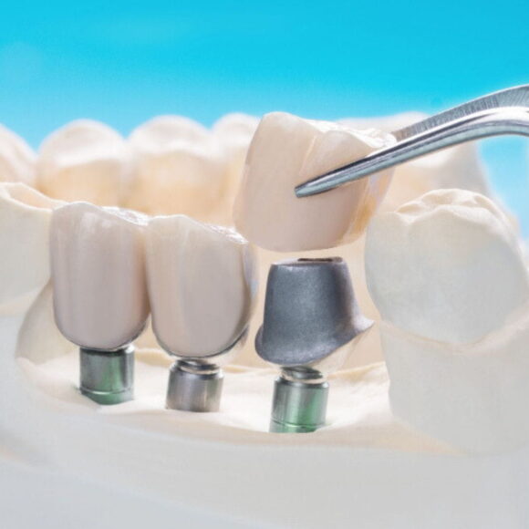 Korona implantologiczna – rodzaje i cena