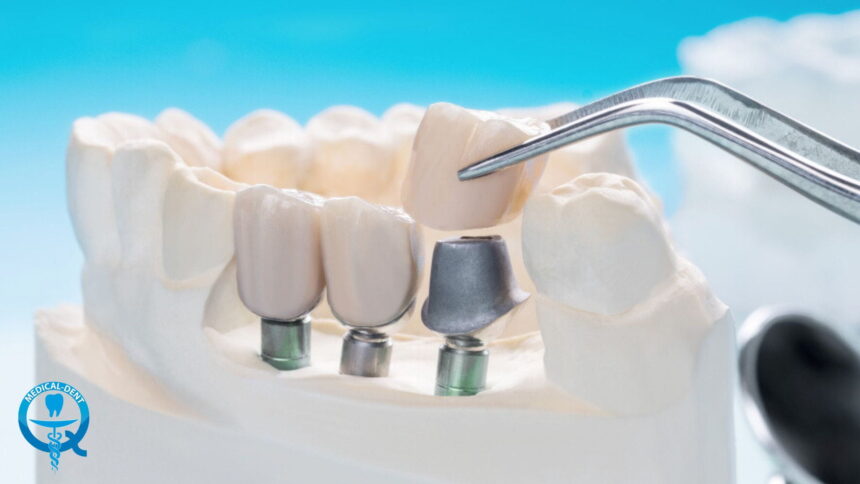 Korona implantologiczna – rodzaje i cena Korona implantologiczna – rodzaje i cena