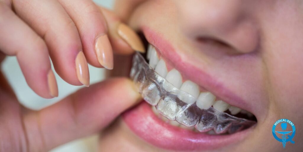 Žena si nasadzuje na zuby priehľadnú ortodontickú šablónu Invisalign a prstami si ju pridržiava pri ústach