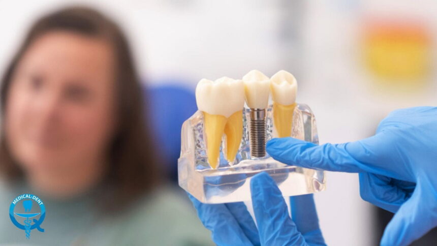 Ile wytrzyma implant zęba? Ile wytrzyma implant zęba?